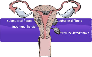 fibroids_395x243